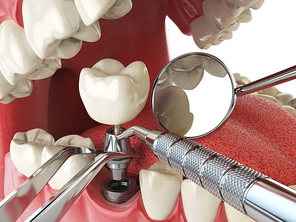Urgent Tooth Repair in NY